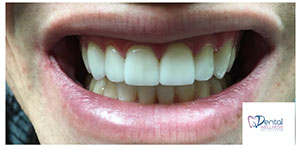 Veneers After